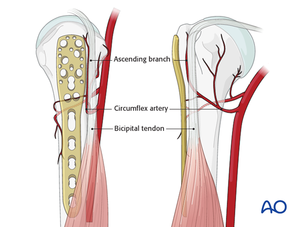 Pitfall: plate too close to the bicipital groove