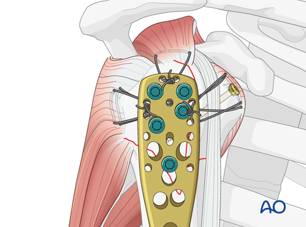 Lesser tuberosity fixation