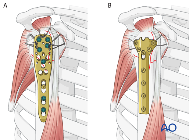 Sometimes, these implants are not available. Standard plates provide an alternative option, for example the modified cloverleaf.