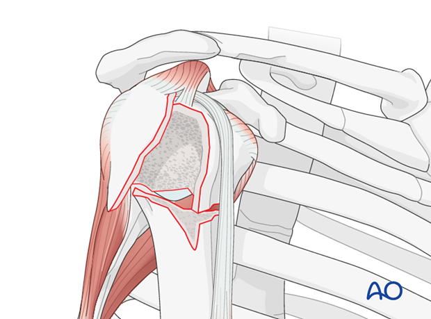 reverse arthroplasty