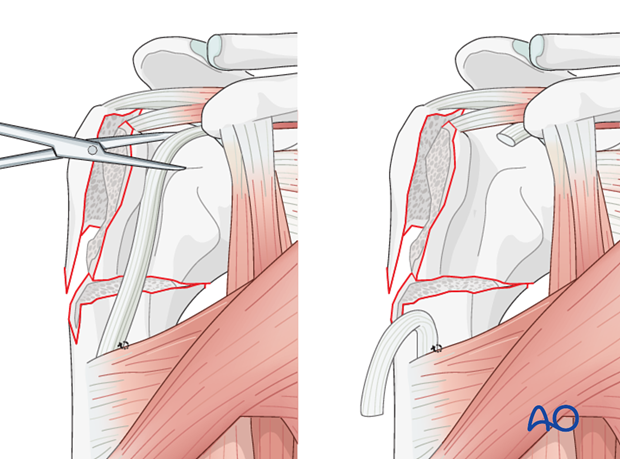 reverse arthroplasty