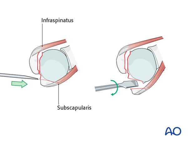 reverse arthroplasty