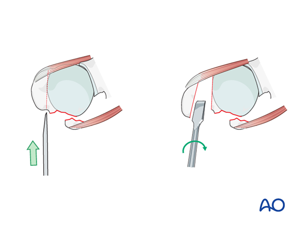 reverse arthroplasty