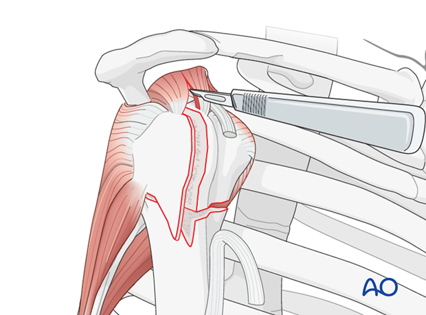 reverse arthroplasty