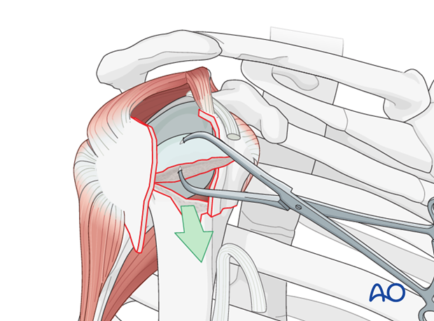 reverse arthroplasty