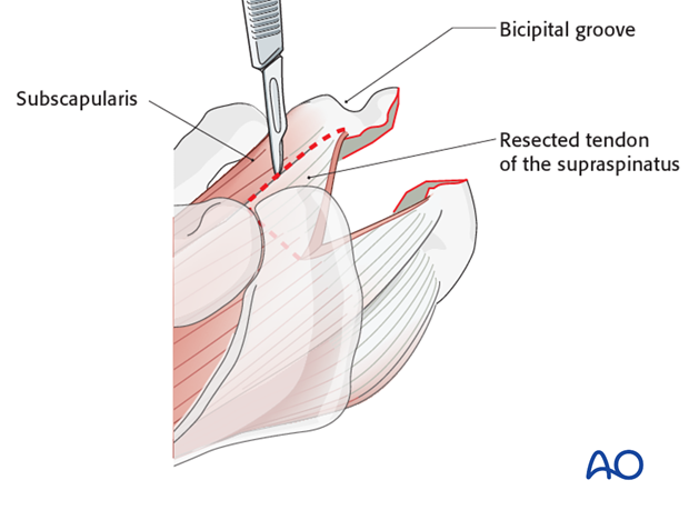 reverse arthroplasty