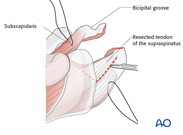 reverse arthroplasty