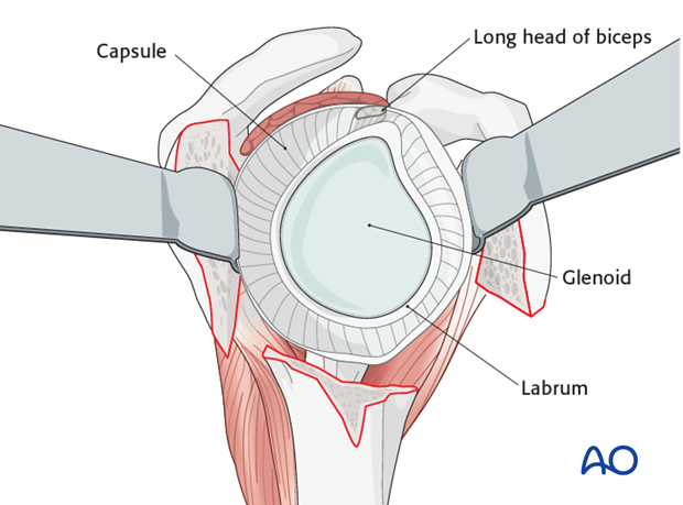 reverse arthroplasty