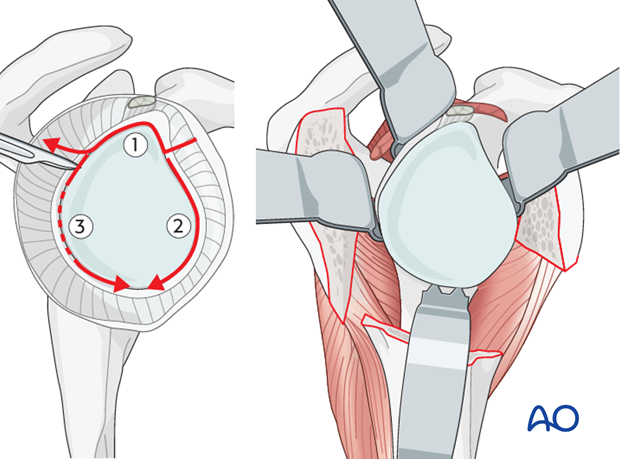 reverse arthroplasty