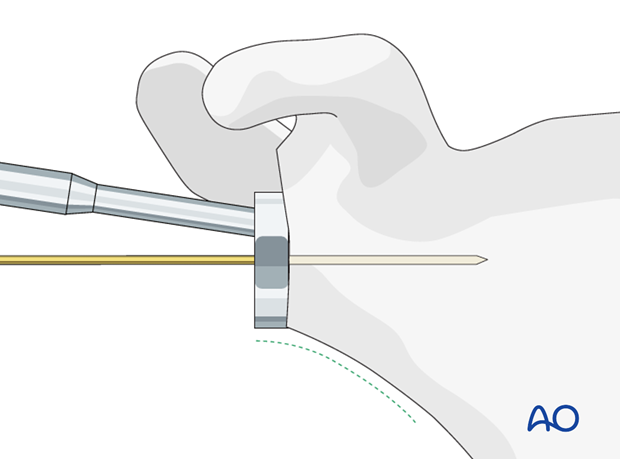 reverse arthroplasty