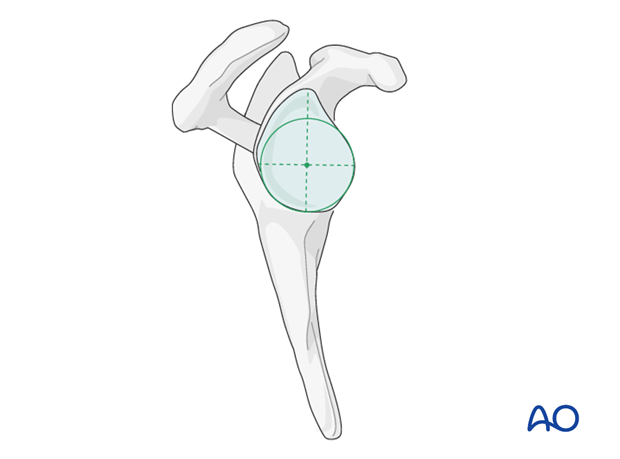 reverse arthroplasty