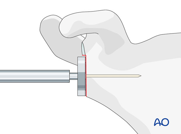 reverse arthroplasty