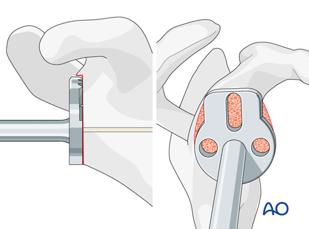 reverse arthroplasty