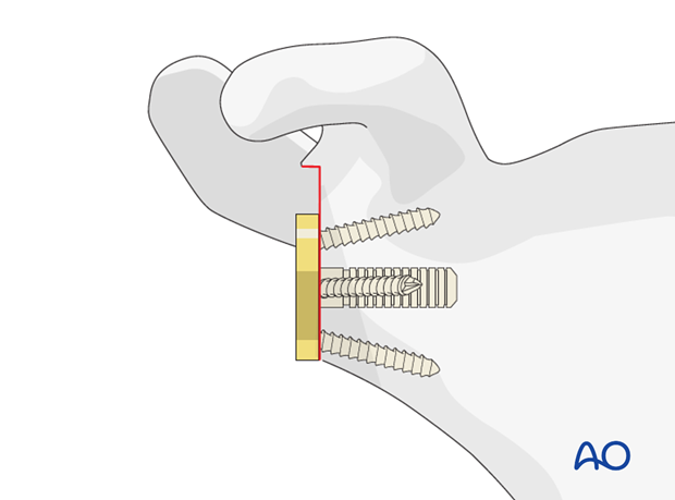 reverse arthroplasty