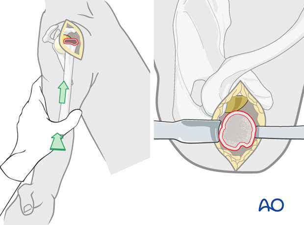 reverse arthroplasty