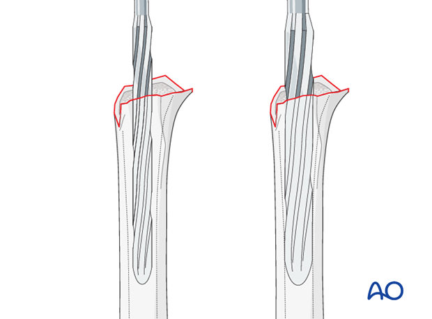 reverse arthroplasty