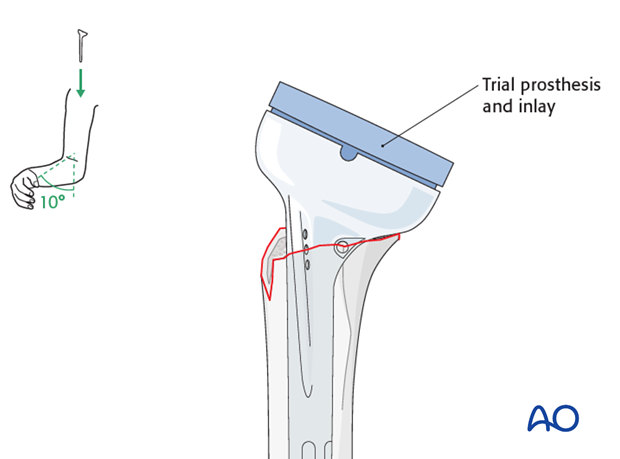 reverse arthroplasty