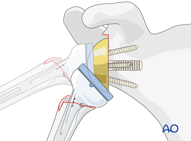 reverse arthroplasty