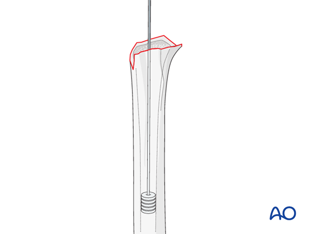 reverse arthroplasty