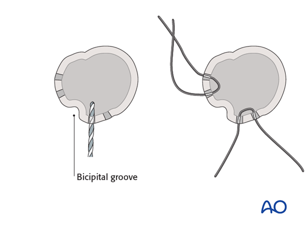 reverse arthroplasty