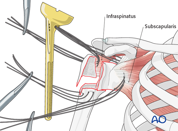 reverse arthroplasty