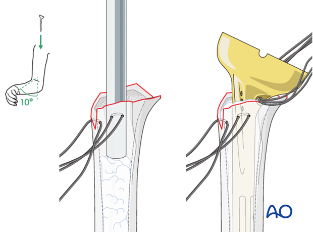 reverse arthroplasty