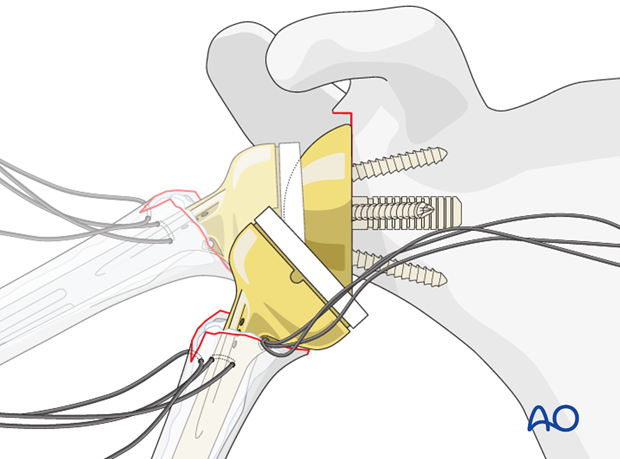 reverse arthroplasty