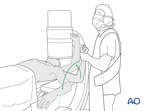 Carefully check for correct reduction and fixation (including proper implant position and length) at various arm positions. 