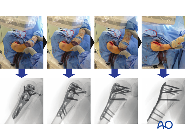 Dynamic image intensification of a proximal humeral fracture with plate fixation