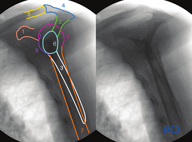 Anatomical lines and landmarks of the shoulder in the scapula-Y view