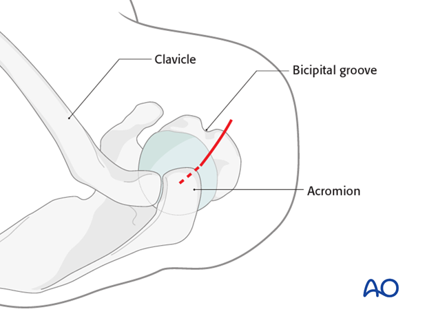 Anterolateral transdeltoid approach for antegrade nailing