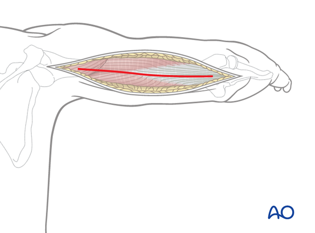 Superficial dissection