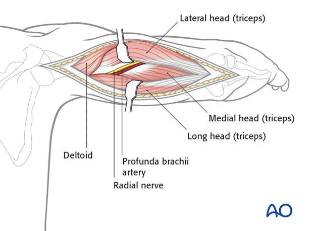 Posterior triceps-split approach