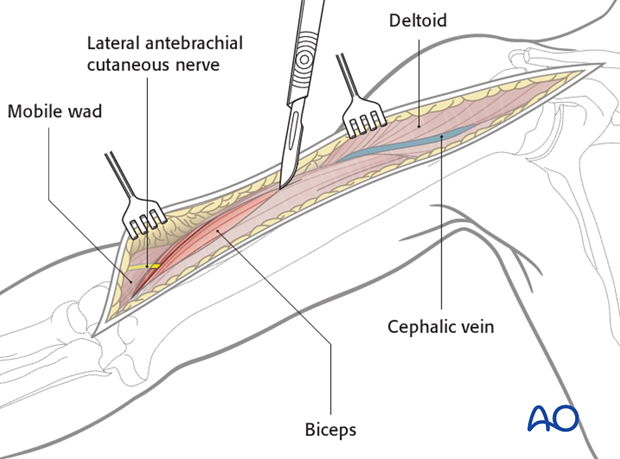 Incise the fascia carefully between biceps/brachialis and the mobile wad.