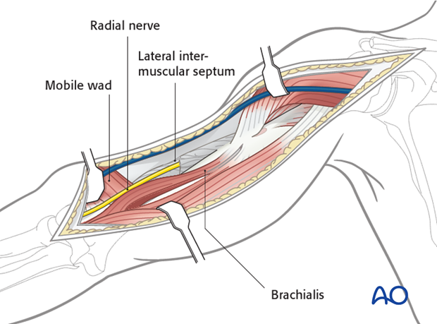 Distally, the anterior humerus has been exposed to the elbow joint, between the mobile wad and brachialis.