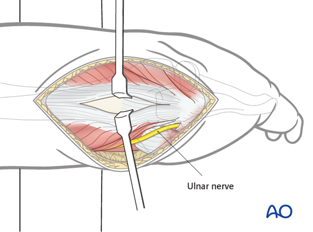 Split the triceps tendon longitudinally.