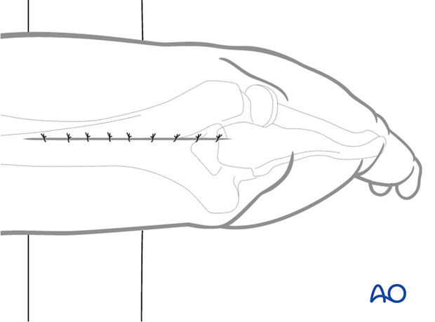 Close the subcutaneous tissue and skin.