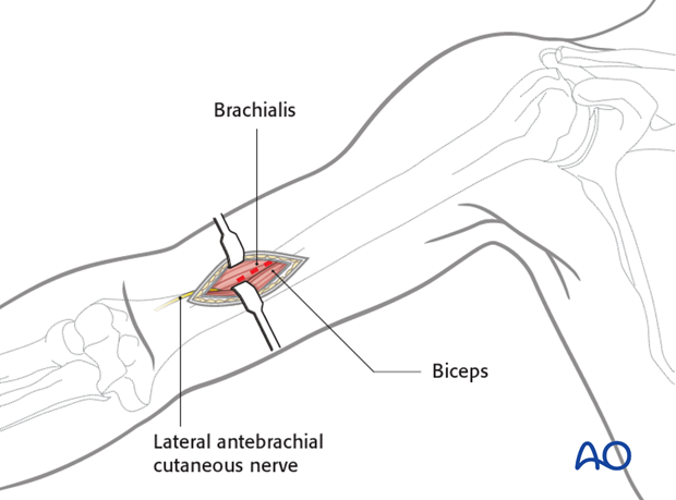 Distal portal