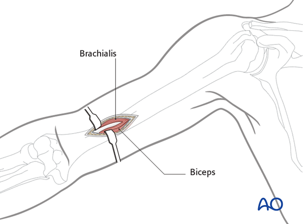 Distal portal