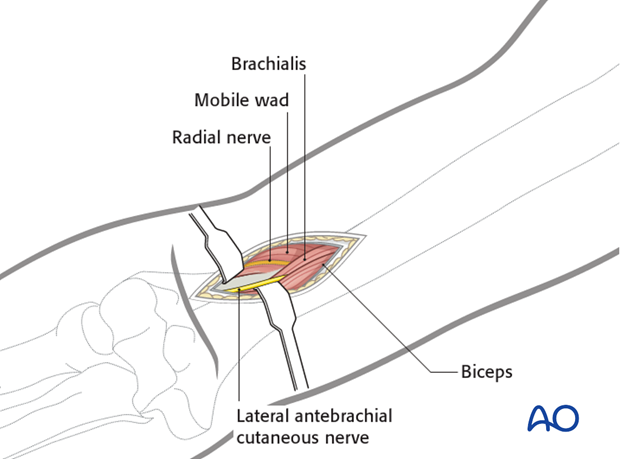 Distal portal