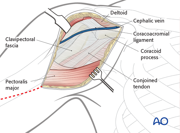 Dissection down to the deltopectoral groove