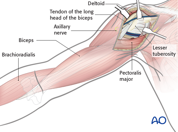 Exposure of the proximal humerus