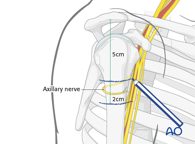 Before incising the skin, mark the distal limit of the approach