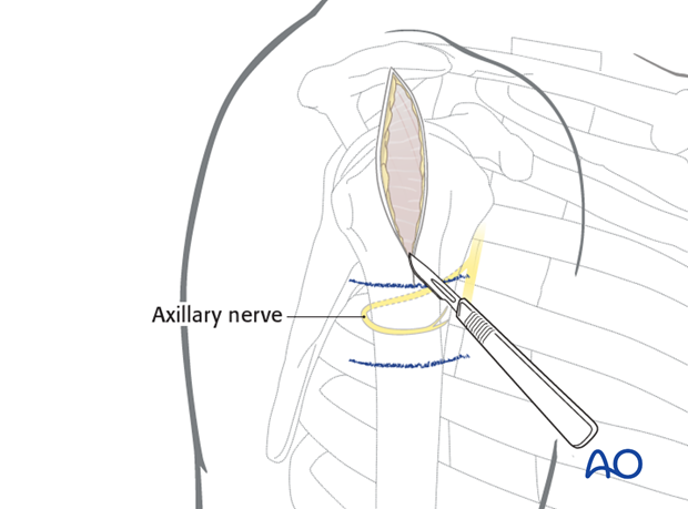 Make a skin incision from the lateral border of the acromion 5 cm distally, parallel to the axis of the humerus.