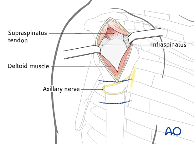 Exposure of the middle third part of the deltoid muscle