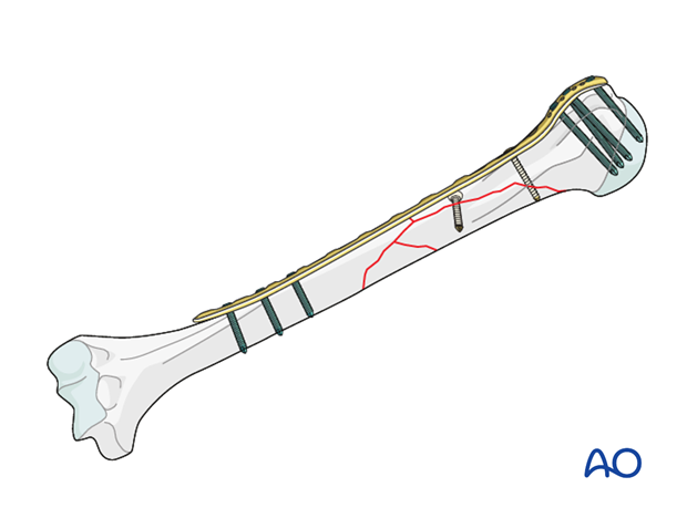 Plating of proximal 1/3 fractures