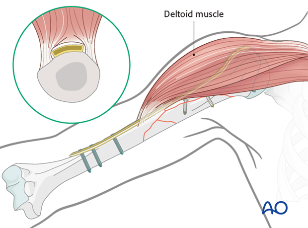 Plating of proximal 1/3 fractures