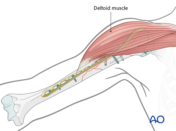 Plating of proximal 1/3 fractures