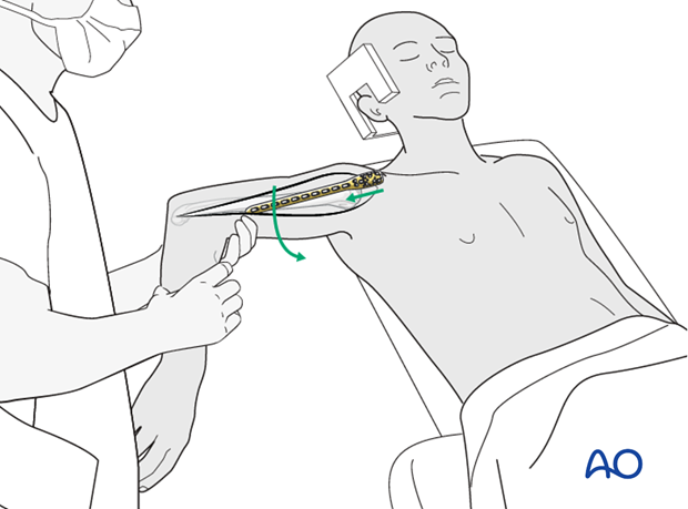 Plating of proximal 1/3 fractures