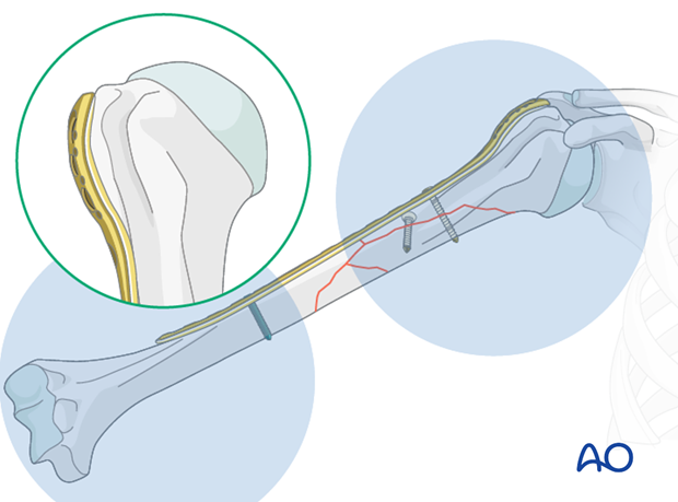 Confirm the plate position by palpation and under image intensification.